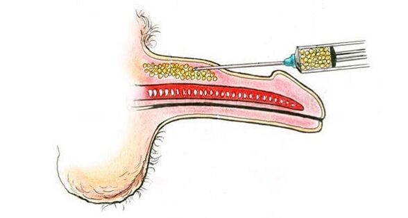 Inject hyaluronic acid into a member's box to increase it